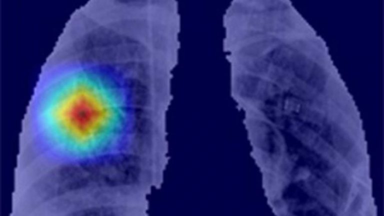 Lanzan ‘CoronavIAruX’, una herramienta de diagnóstico del Covid-19 basada en inteligencia artificial