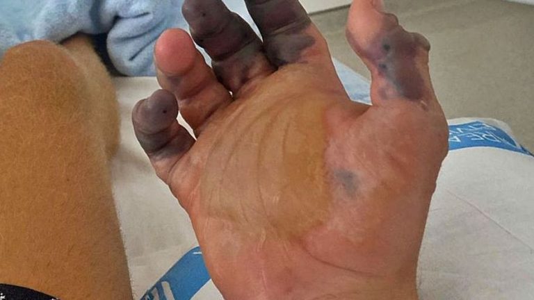 La picadura de araña de Ibiza es el primer caso que obliga a amputar dedos en España
