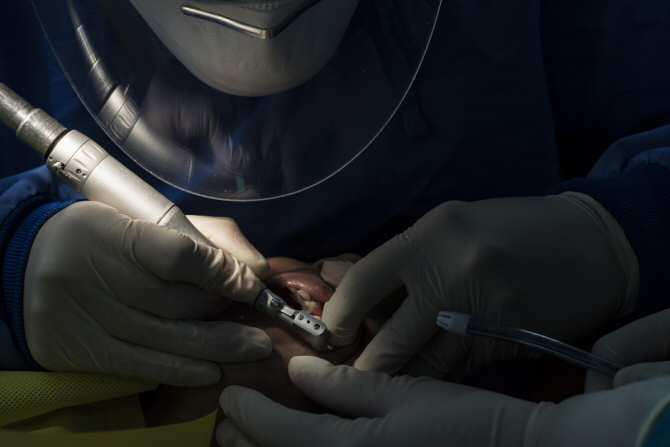 Regenerar la encía alrededor de los implantes dentales