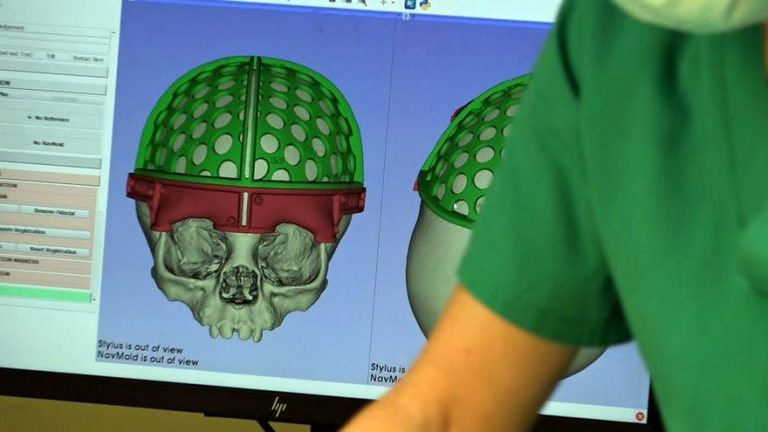 El Marañón usa una técnica pionera para tratar a bebés con malformaciones
