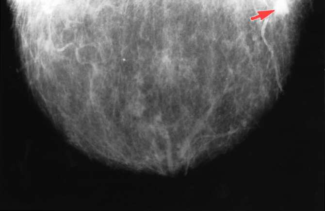 Cribado molecular y cáncer de mama