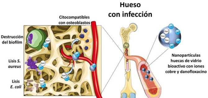 Nanovehículo portador de antibiótico y cobre para tratar infecciones óseas