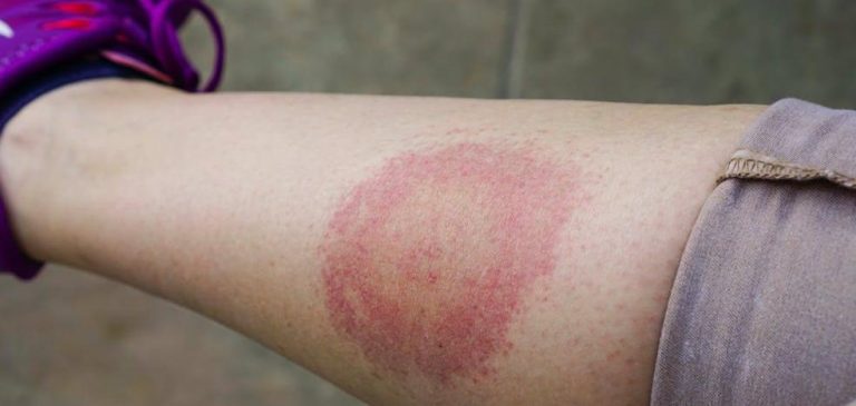 Por qué están aumentando los casos de la enfermedad de Lyme en España